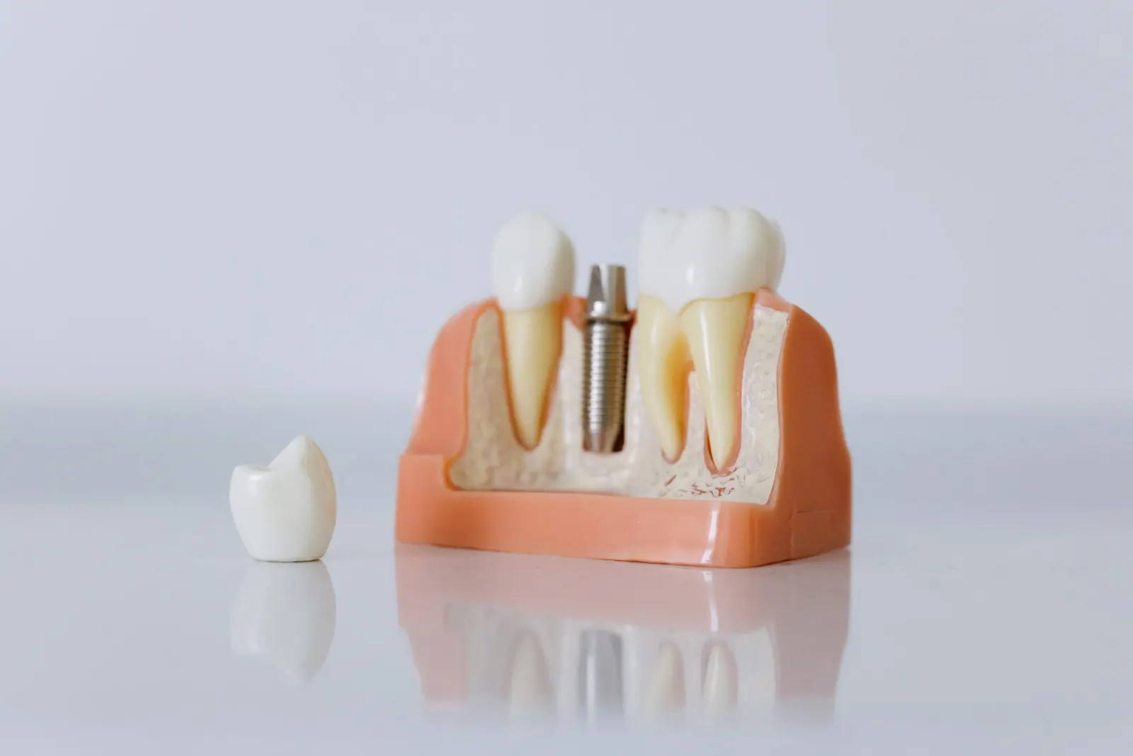 Dental Implant or Bridge: How the Decision Is Actually Made
